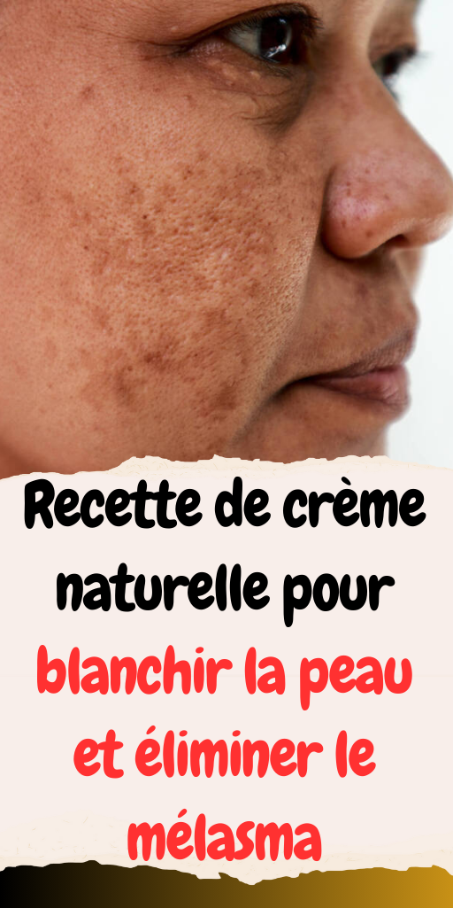 blanchir la peau et éliminer le mélasma