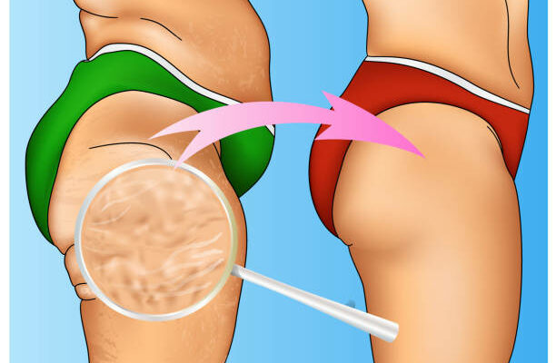 Cellulite