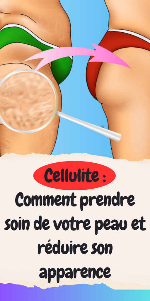 Cellulite 