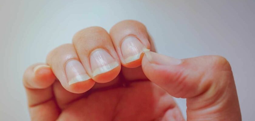 prévenir la casse des ongles