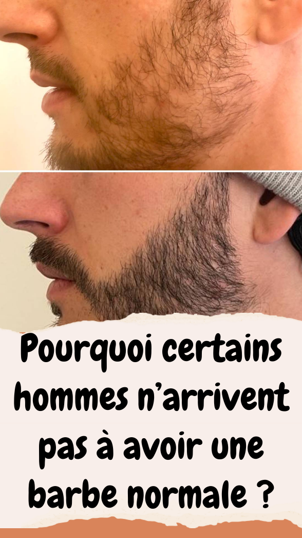 Pourquoi certains hommes n’arrivent pas à avoir une barbe normale ?