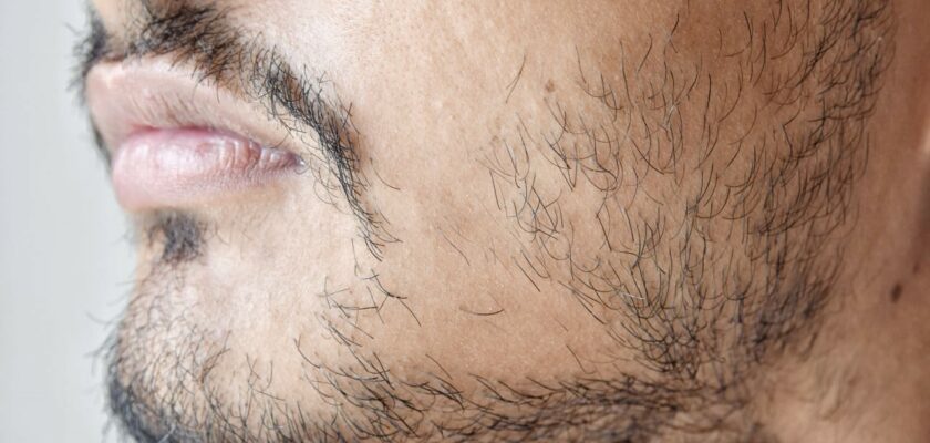 Pourquoi certains hommes n’arrivent pas à avoir une barbe normale ?